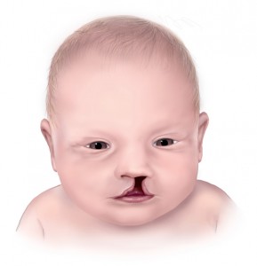 cleftlip- CDC