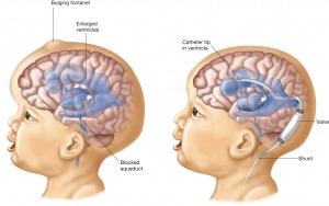 hydrocephalus 