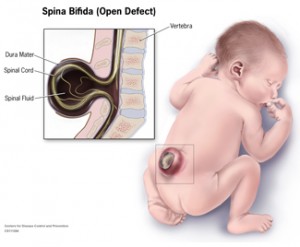spina bifida