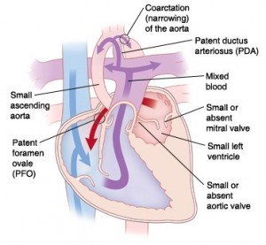 left hypoplastic syndrome
