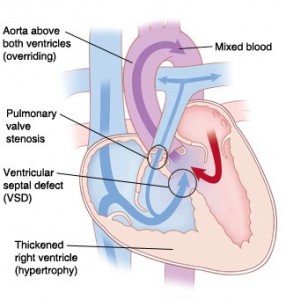 tetralogy of fallot
