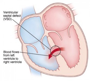ventricular septal defect